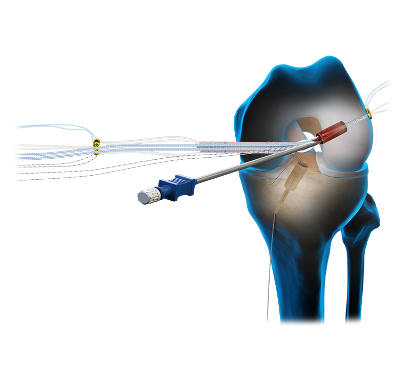 Arthrex - BioXpress Graft Delivery Device, 10 cm, Blunt Tip - ABS